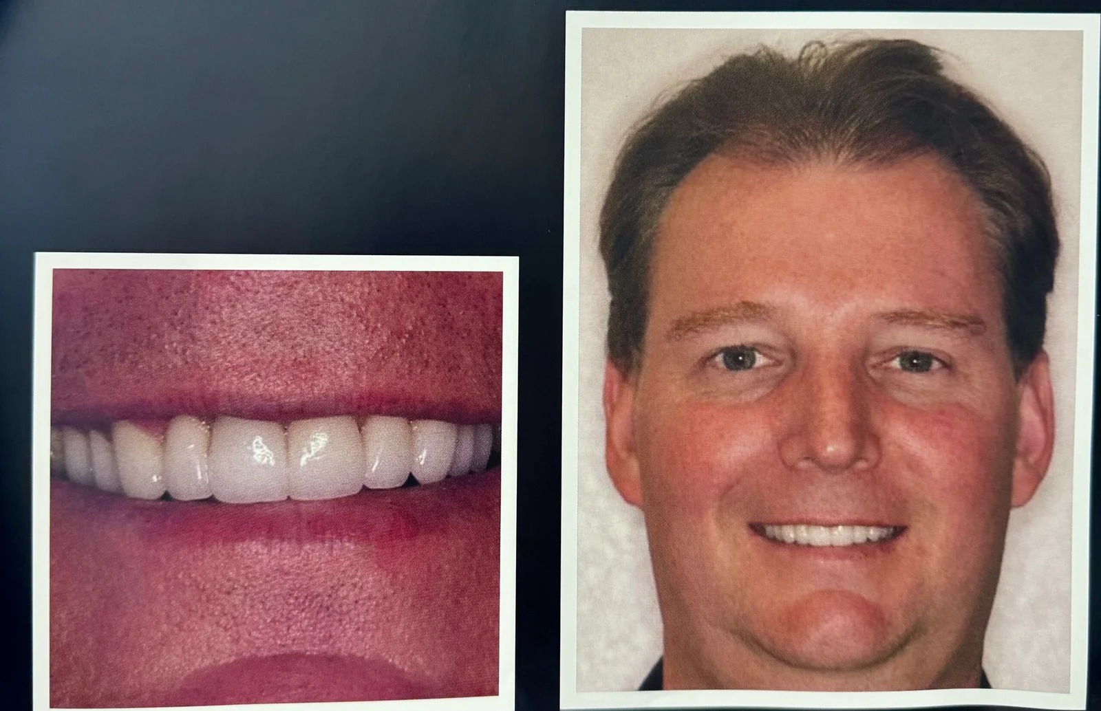 After treatment: custom porcelain restorations created a healthy, natural-looking smile, restoring confidence and enhancing overall facial harmony.